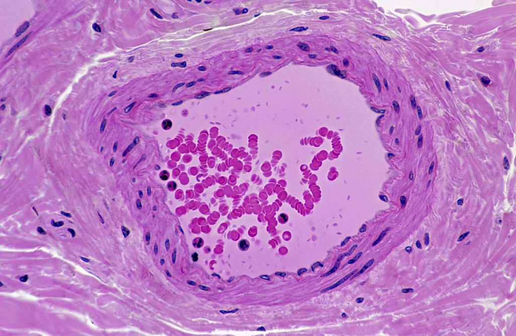 Normal Artery in Cross Section (Magnification x100) H & E stain. Three distinct layers or tunics: tunica interna (intima), tunica media, tunica externa (adventitia). Also shows endothelium and lumen with red and white blood cells.