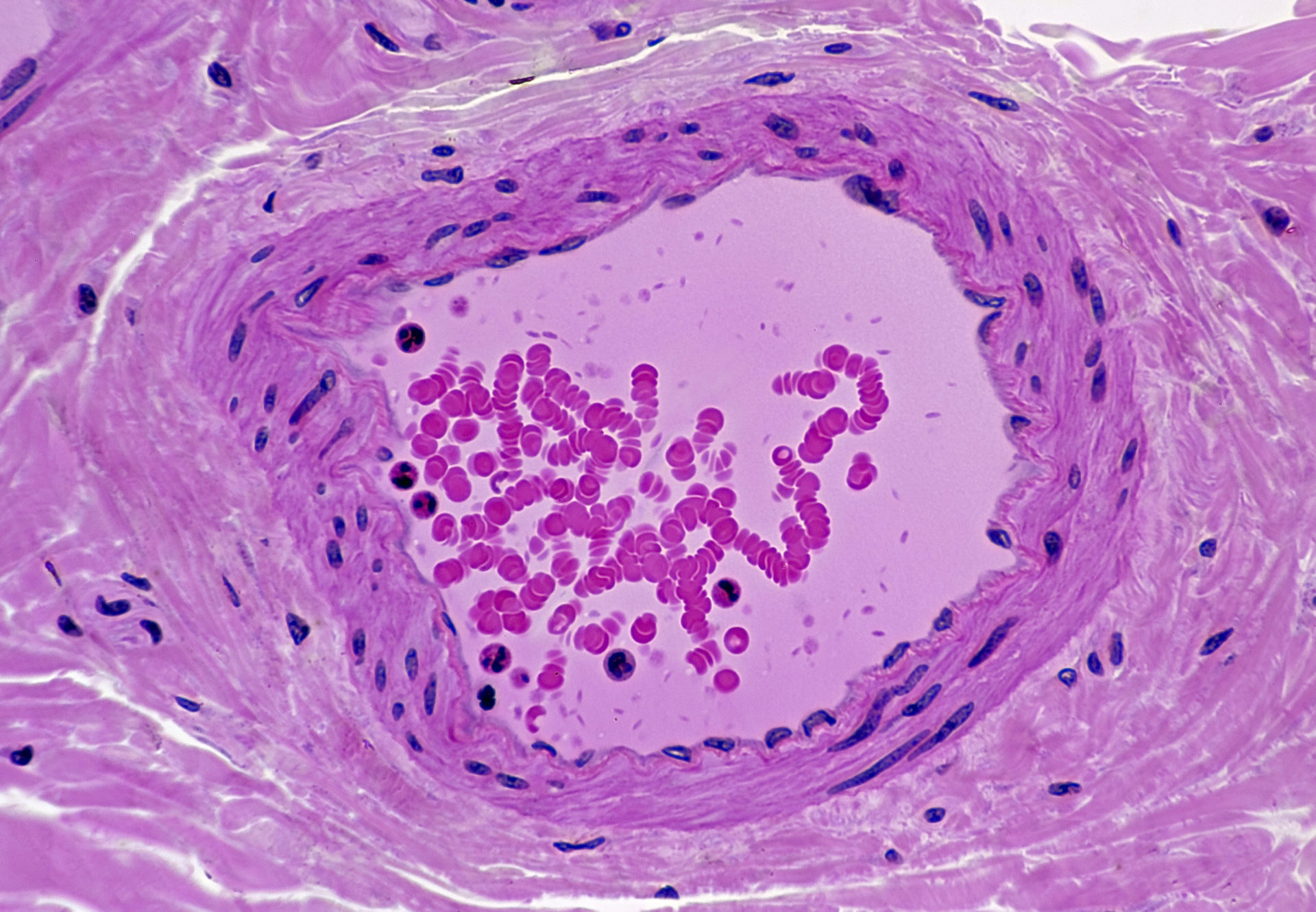 Normal Artery in Cross Section (Magnification x100) H & E stain. Three distinct layers or tunics: tunica interna (intima), tunica media, tunica externa (adventitia). Also shows endothelium and lumen with red and white blood cells.